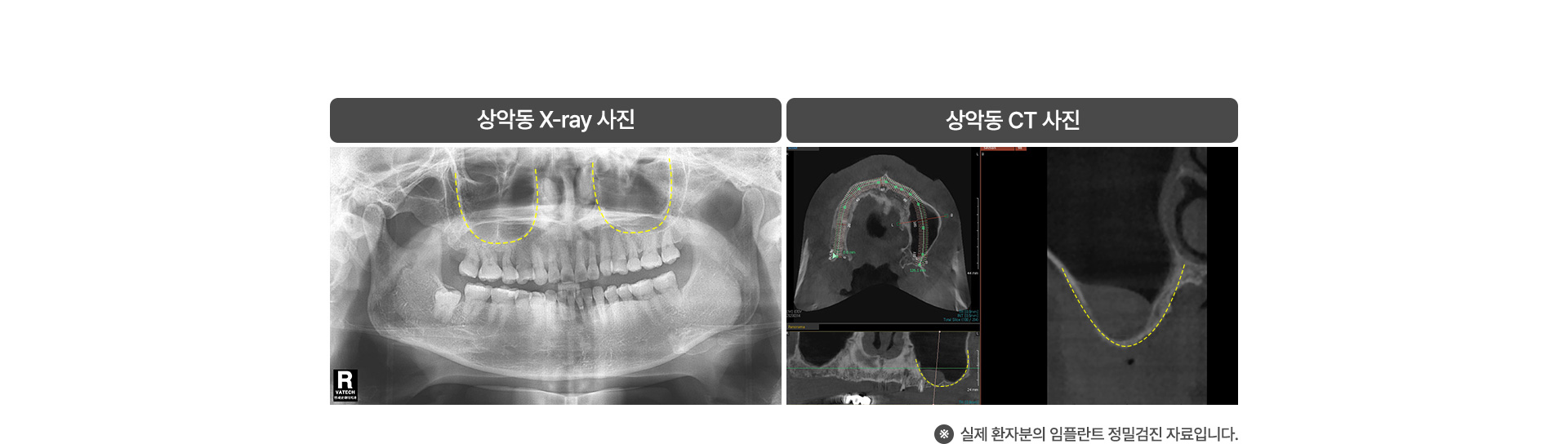 상악동거상술