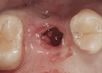 임플란트재수술