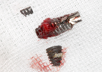 임플란트재수술