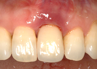 임플란트재수술