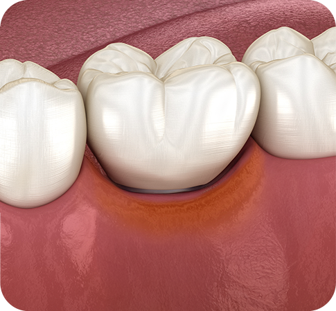 임플란트재수술