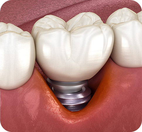 임플란트재수술