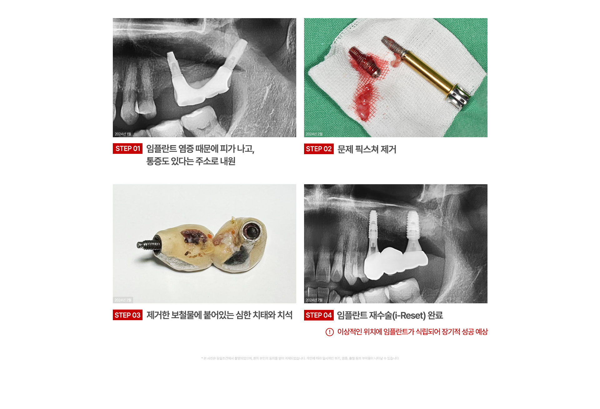 임플란트재수술