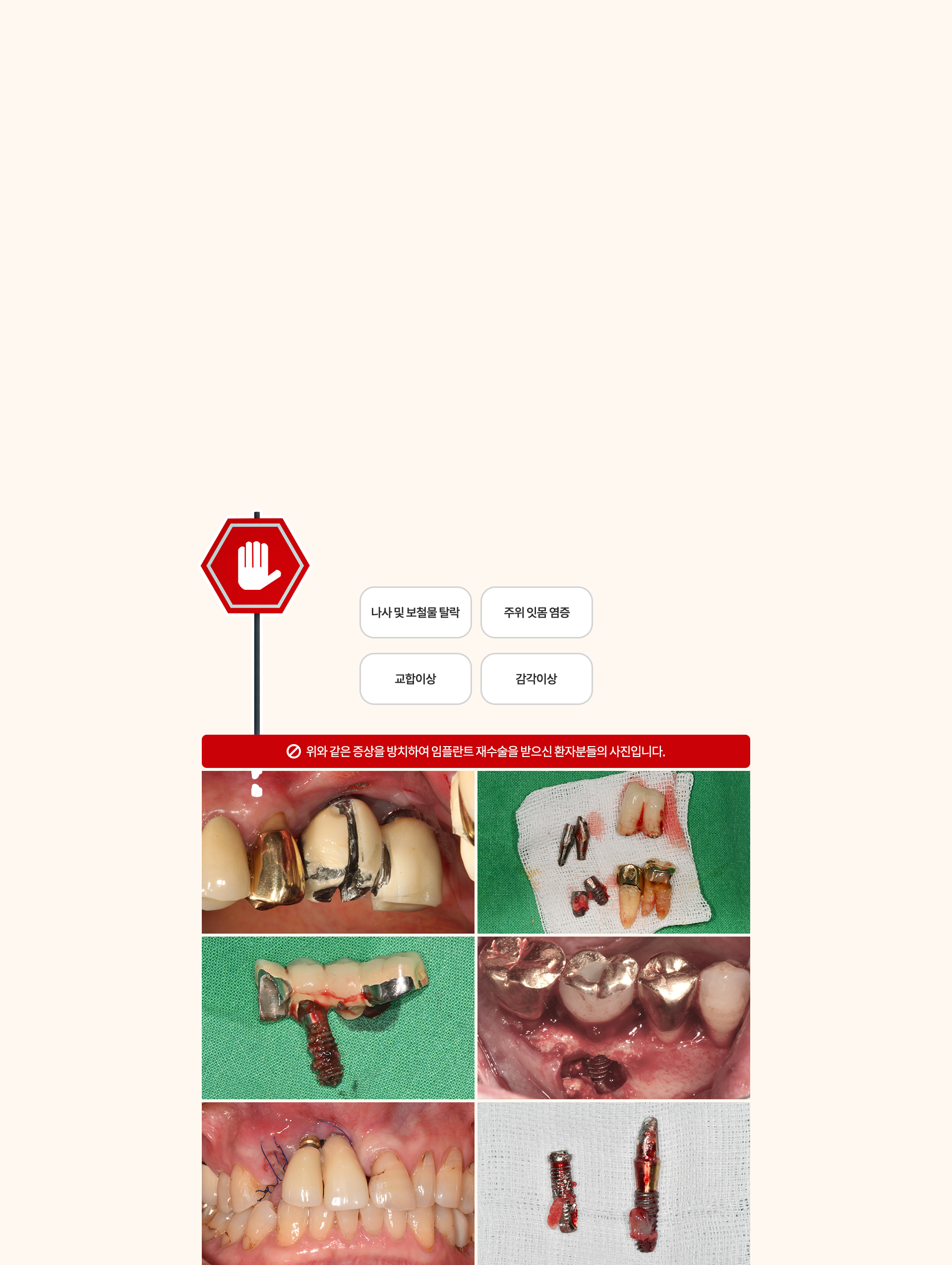 임플란트재수술