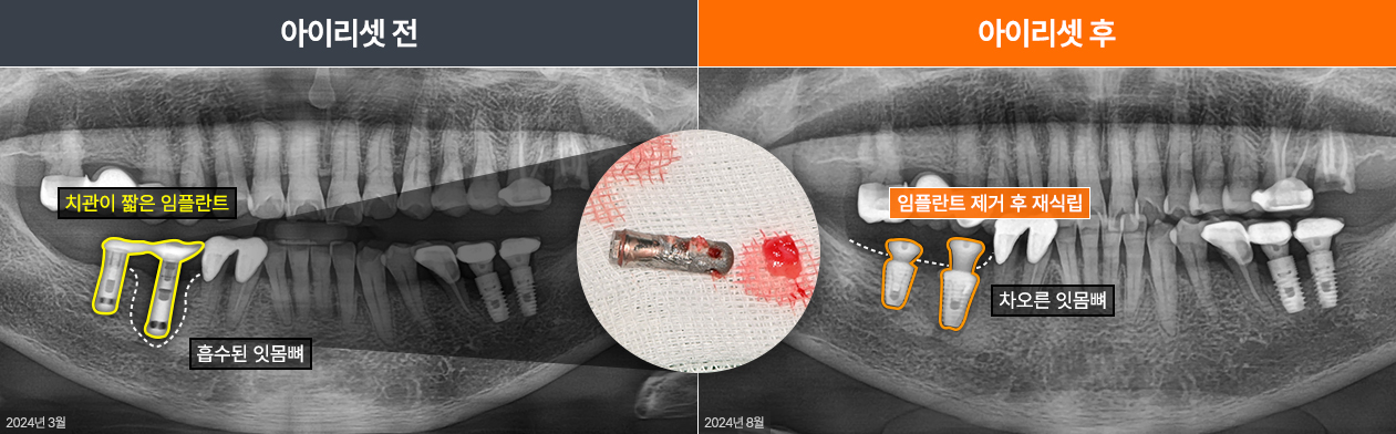 임플란트재수술