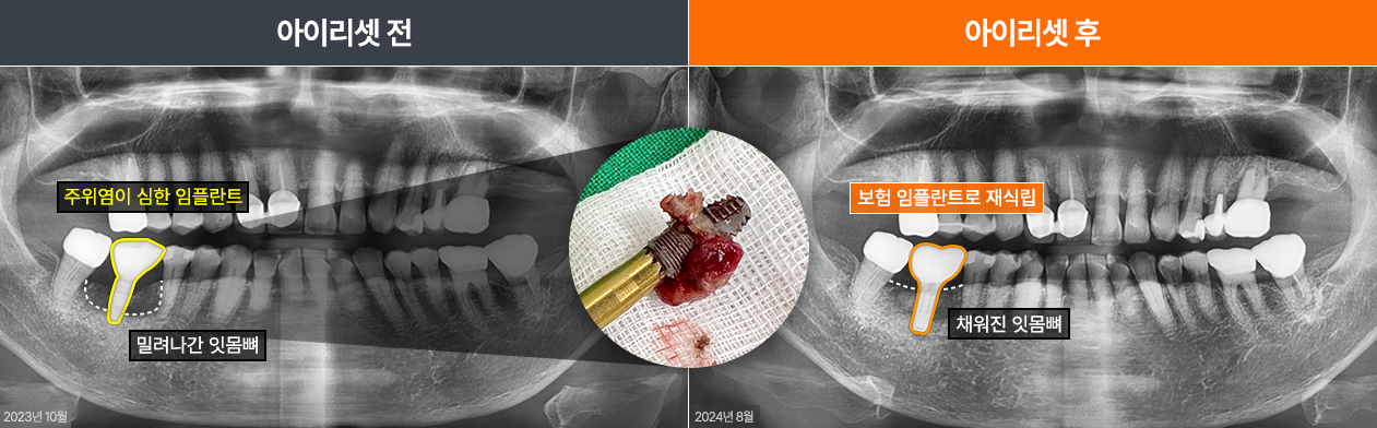 임플란트재수술