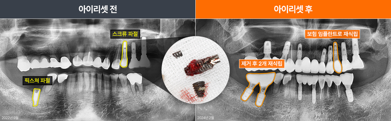 임플란트재수술