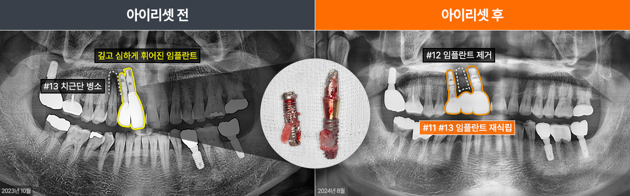 임플란트재수술
