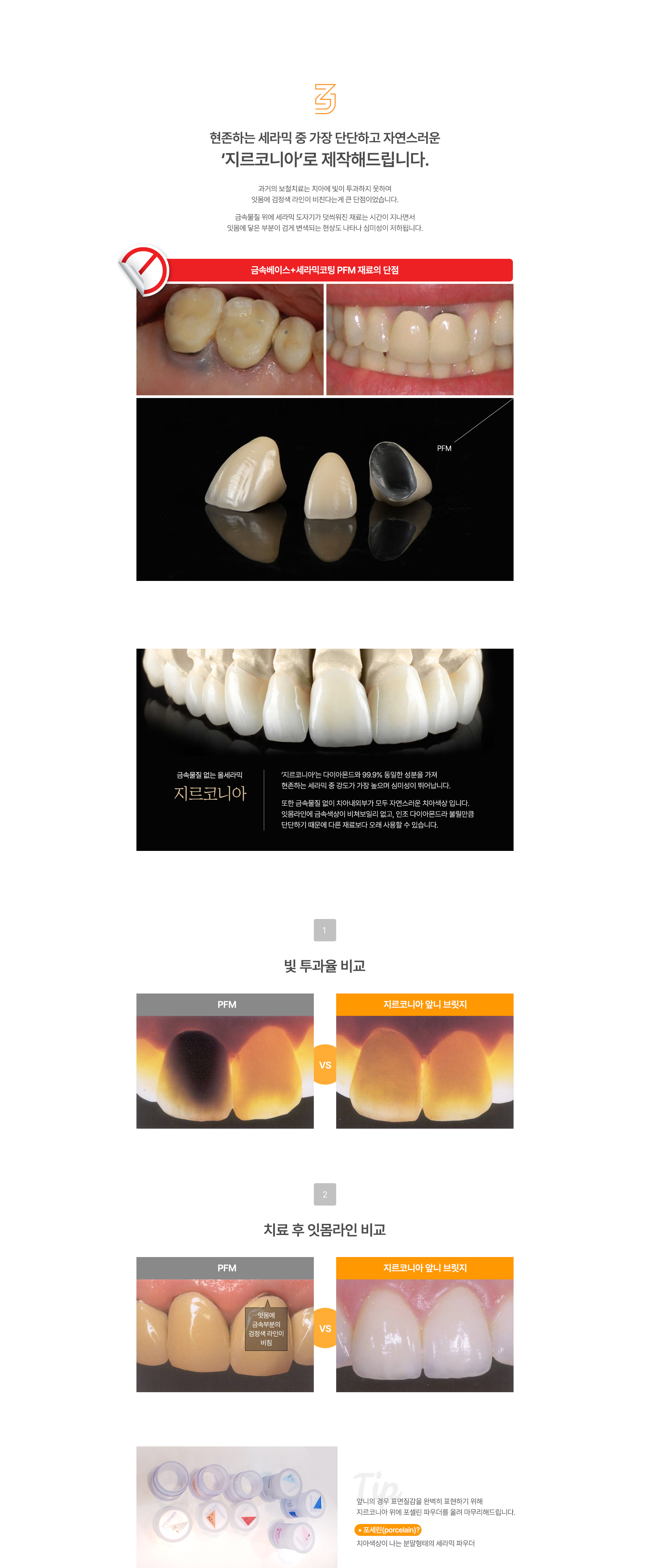 앞니브릿지 재료 지르코니아