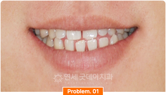벌어진치아로 생기는 발음문제 안내