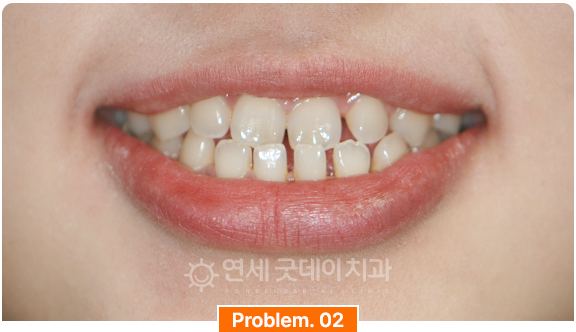 벌어진치아로 생기는 심미적 콤플렉스 안내