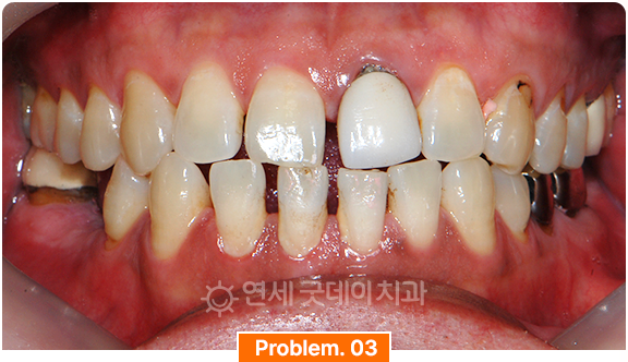 벌어진치아로 생기는 잇몸염증 안내
