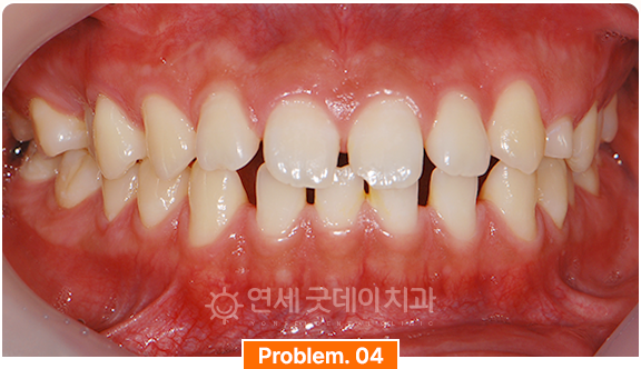 벌어진치아로 생기는 부정교합 안내