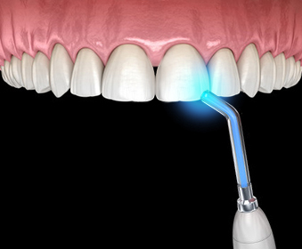 벌어진치아 치료방법 레진