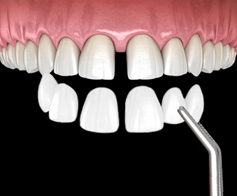 벌어진치아 치료방법 라미네이트