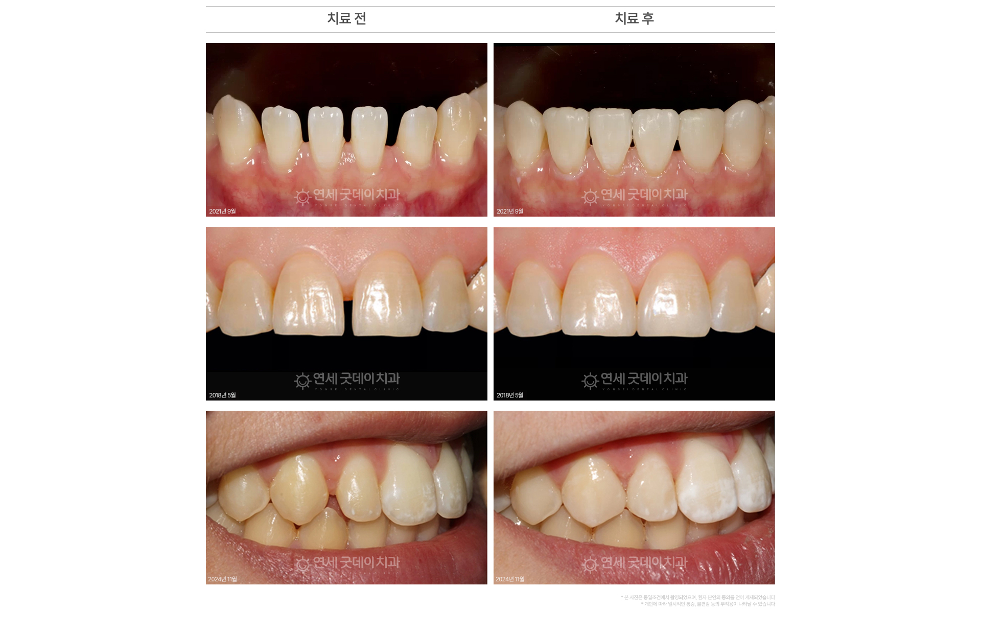 벌어진치아 레진 치료 전후 사례 앞니 사이 틈 레진 치료로 매워진 치아
