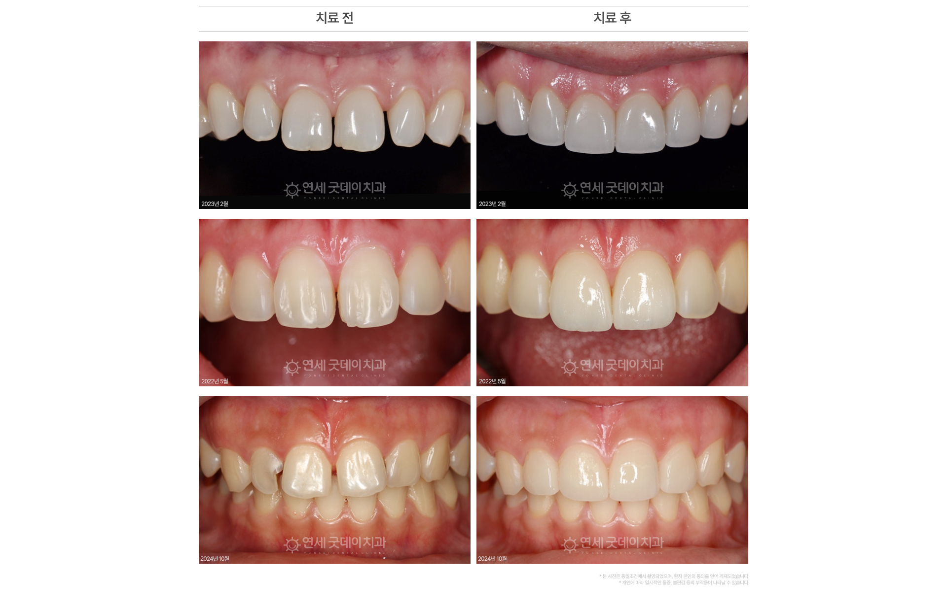벌어진앞니 라미네이트 치료 전후 사례 앞니 사이 간격 축소 형태 대칭 개선
