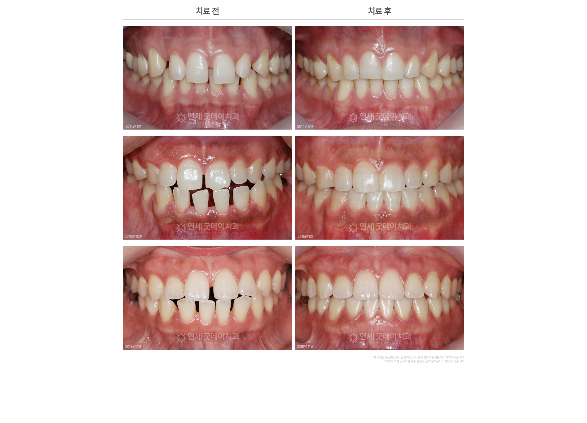 벌어진앞니교정 치료 전후 사례 가장 자연스러운 앞니 치열 개선