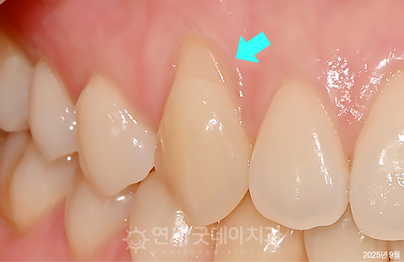 핀홀 잇몸이식수술