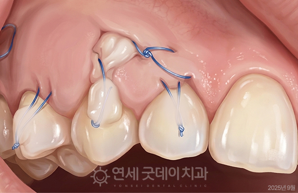 핀홀 잇몸이식수술