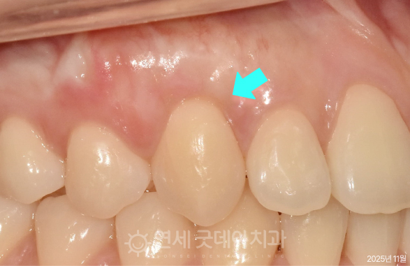 핀홀 잇몸이식수술