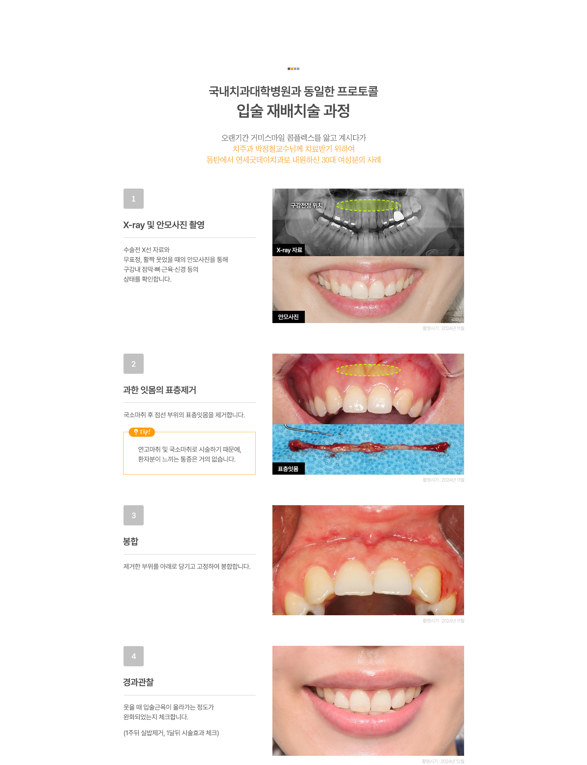 입술 재배치술