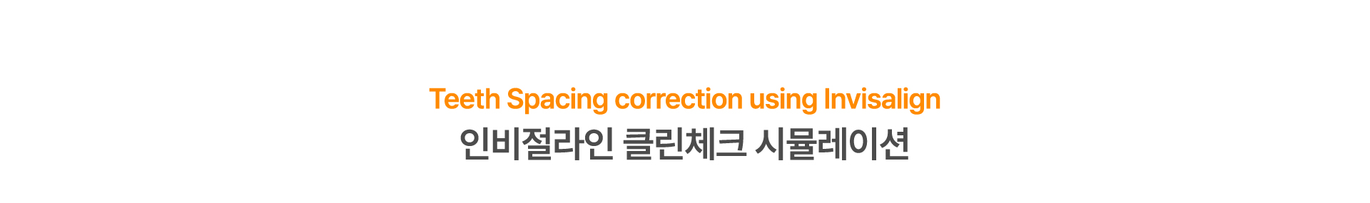 벌어진치아 교정 시뮬레이션 앞니 사이 틈 메우는 과정 미리보기