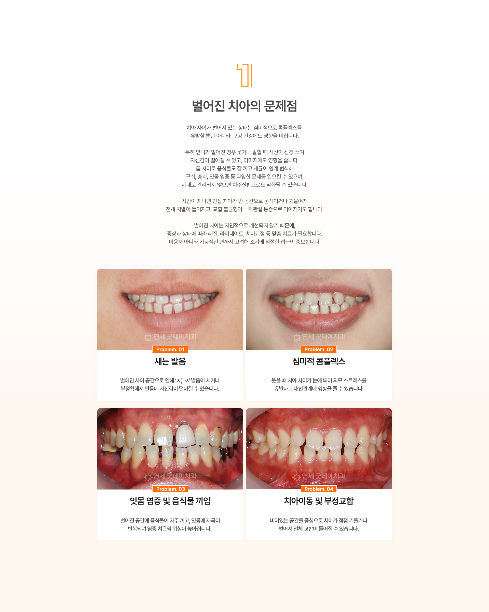 벌어진치아로 생기는 저작문제 발음문제 잇몸염증 부정교합 안내