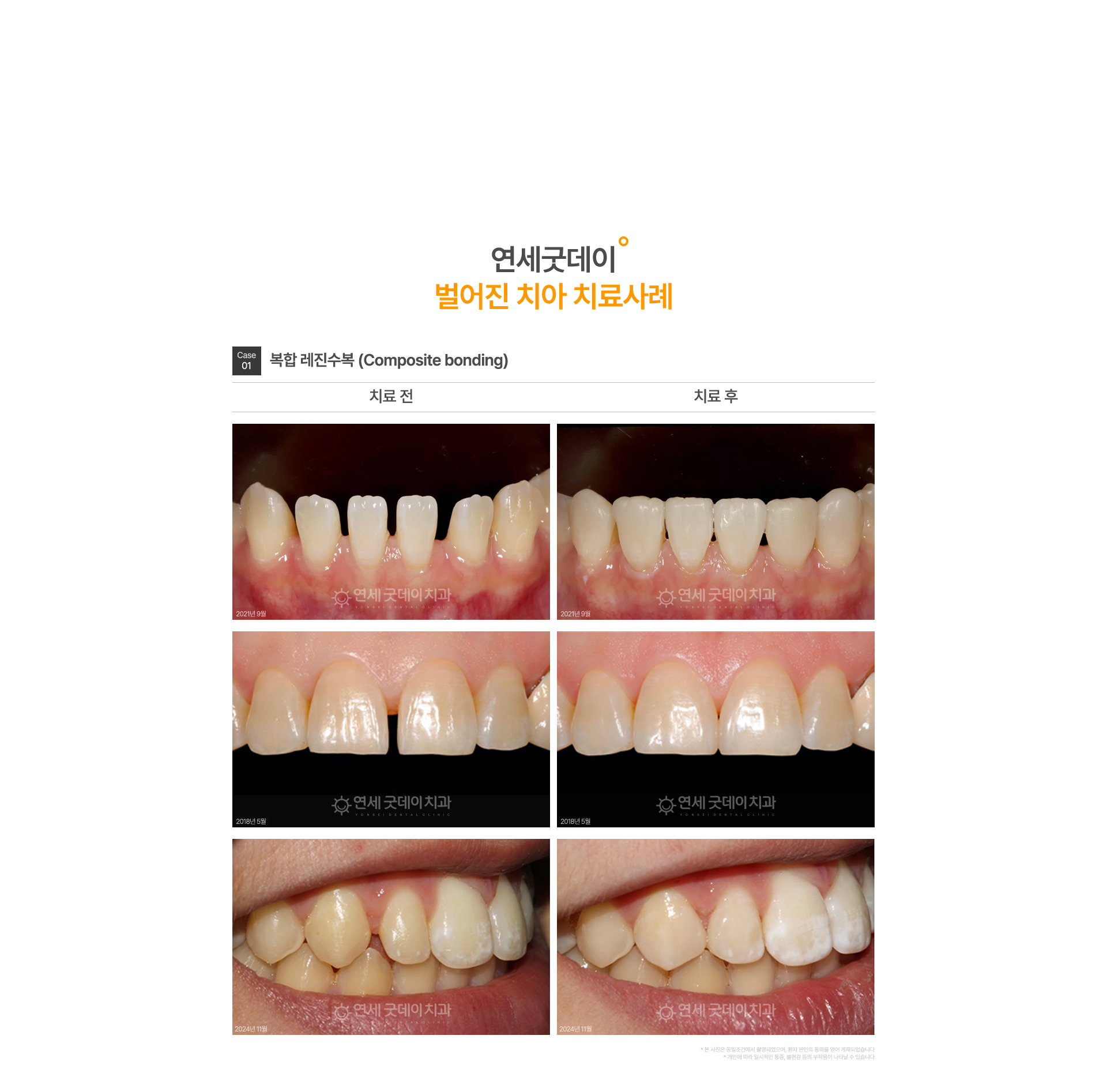 벌어진치아 레진 치료 전후 사례 앞니 사이 틈 레진 치료로 매워진 치아