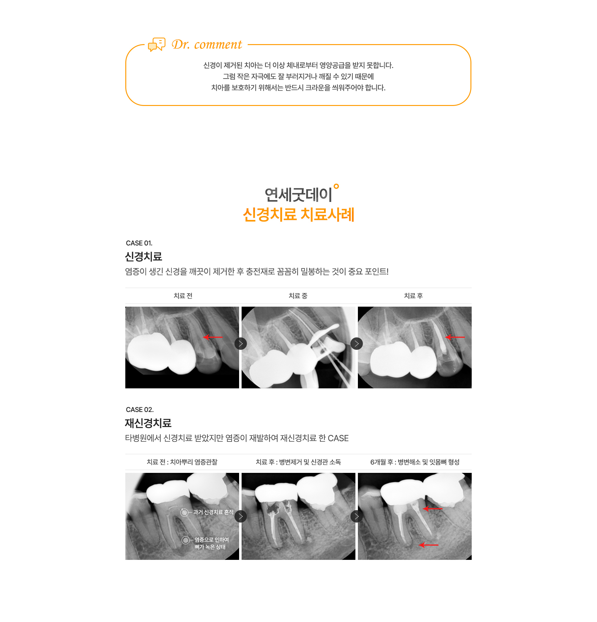 신경치료/재신경치료