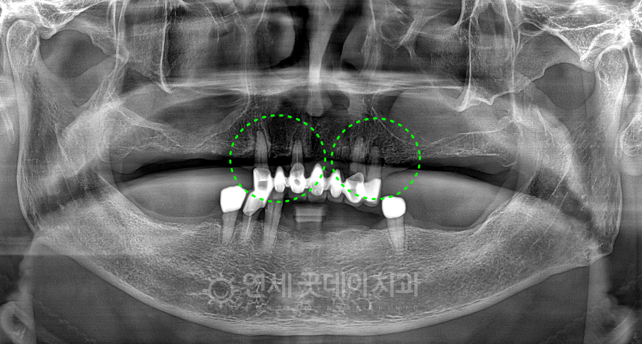 전체임플란트 임플란트 브릿지 치료 전 파노로마 촬영 시행 및 상악 앞니에 관찰되는 치아 염증