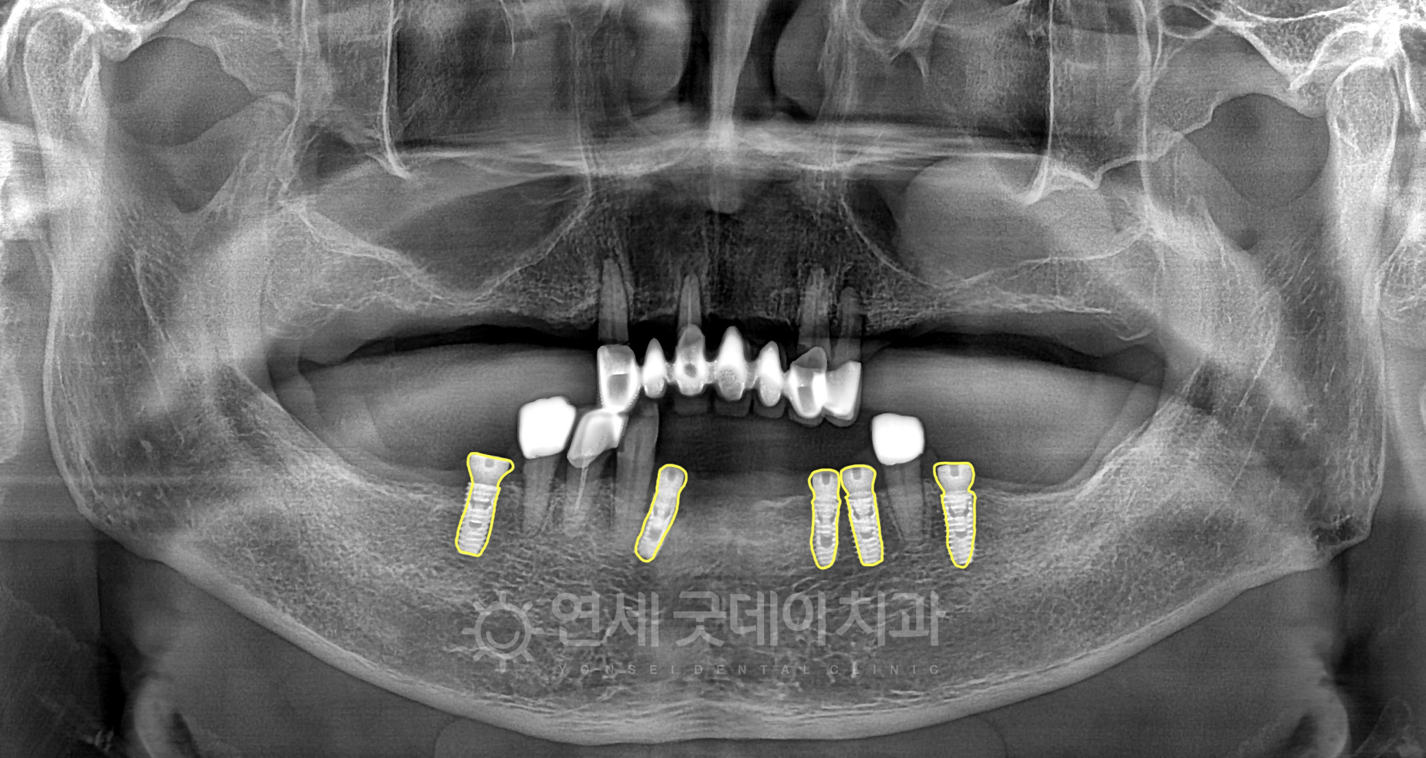 전체임플란트 임플란트 브릿지 식립을 위한 하악 임플란트 5개 식립 및 기존치아 유지