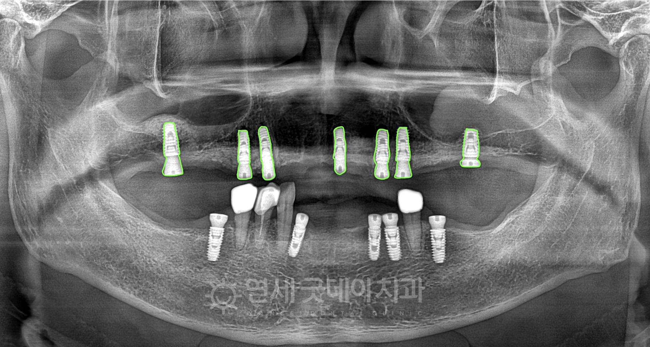 전체임플란트 임플란트 브릿지 치료를 위해 치아 발치 후 최소한의  임플란트 개수인 7개 식립