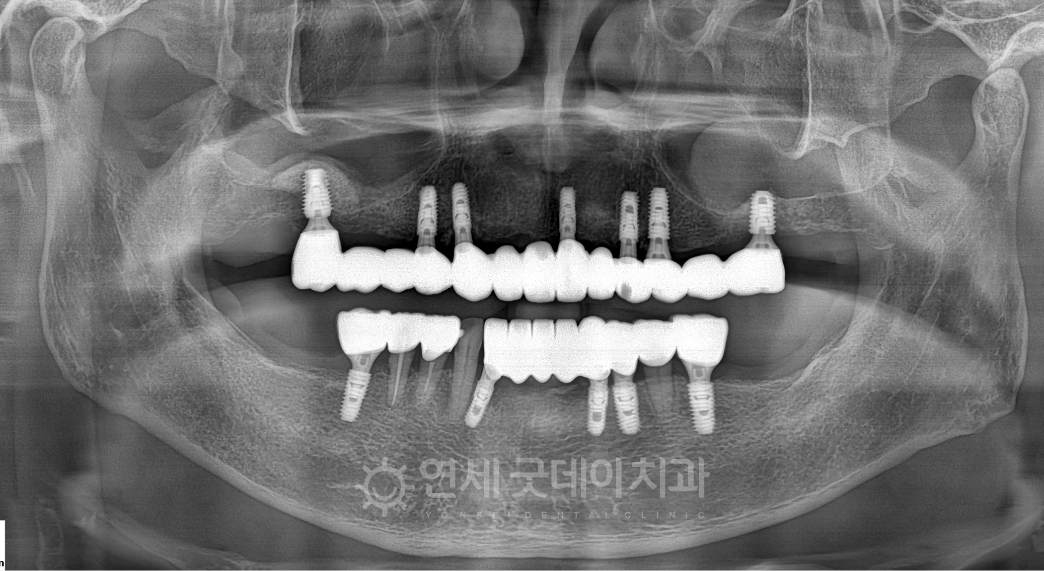 잇몸뼈와 임플란트가 잘 고정된 후 전체임플란트 임플란트 브릿지 보철물까지 제작이 완료된 모습