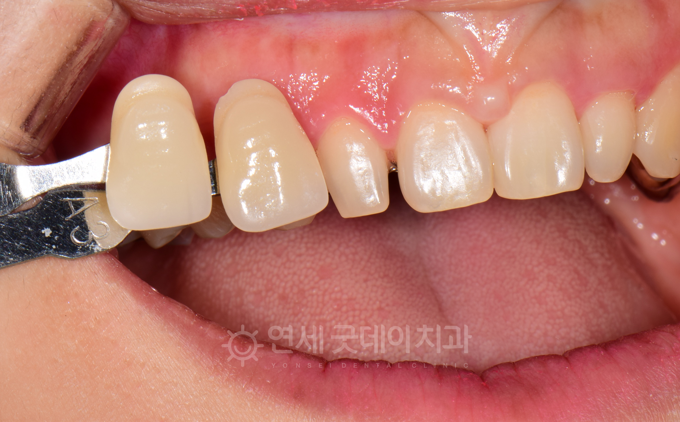 앞니성형인 왜소치 라미네이트를 하기에 앞서 쉐이드가이드를 대조하여 색상과 치아 모양 등을 결정하는 과정