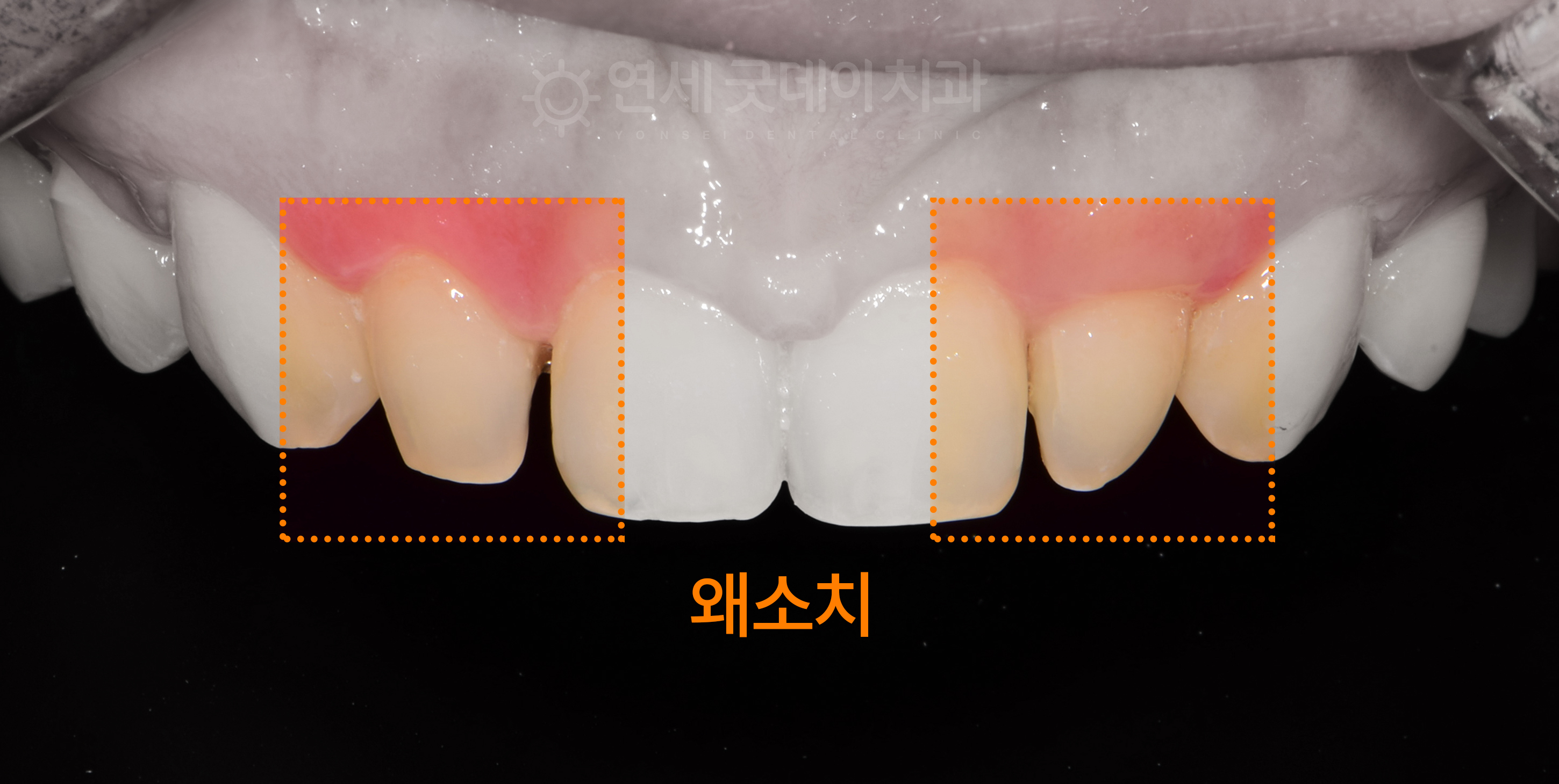 앞니 옆 측절치의 왜소치 라미네이트가 필요하였으며 앞니성형 치은절제술도 함께 진행하기로 치료계획 수립