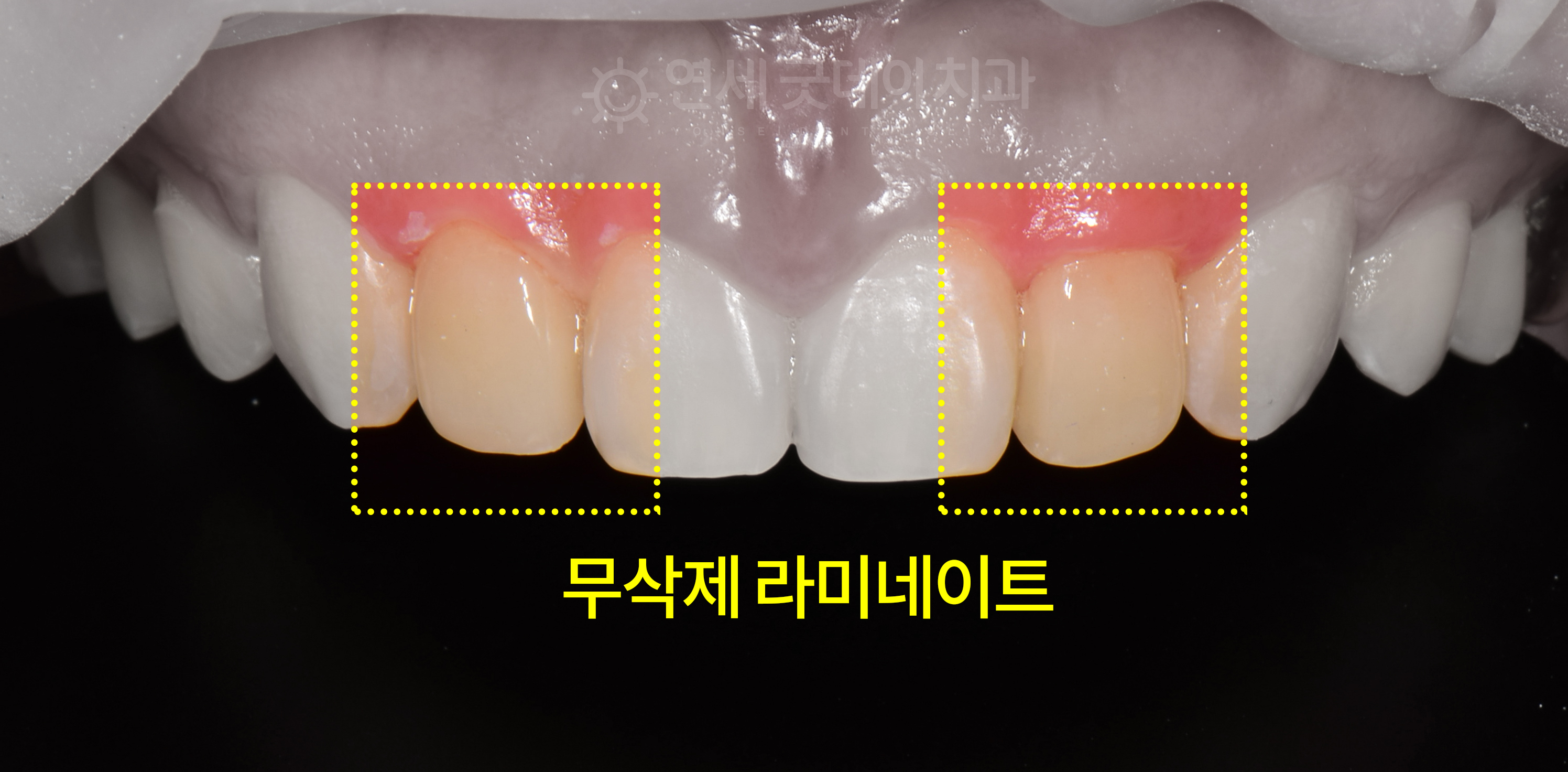 앞니성형 왜소치 라미네이트를 진행한 모습 앞니의 크기와 모양이 균일해진 모습