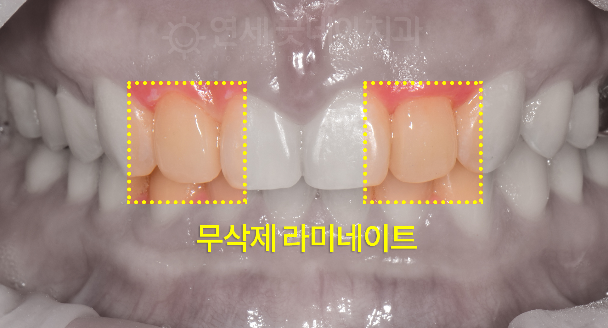 앞니성형 왜소치 라미네이트 치료 후 모습 치은절제술로 인해 잇몸도 자연스러워진 모습