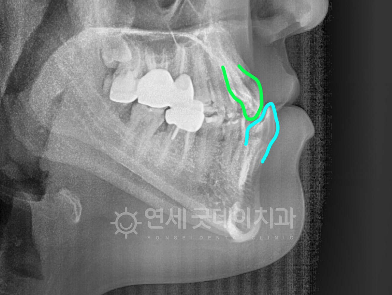 반대교합 교정 전 엑스레이 촬영본