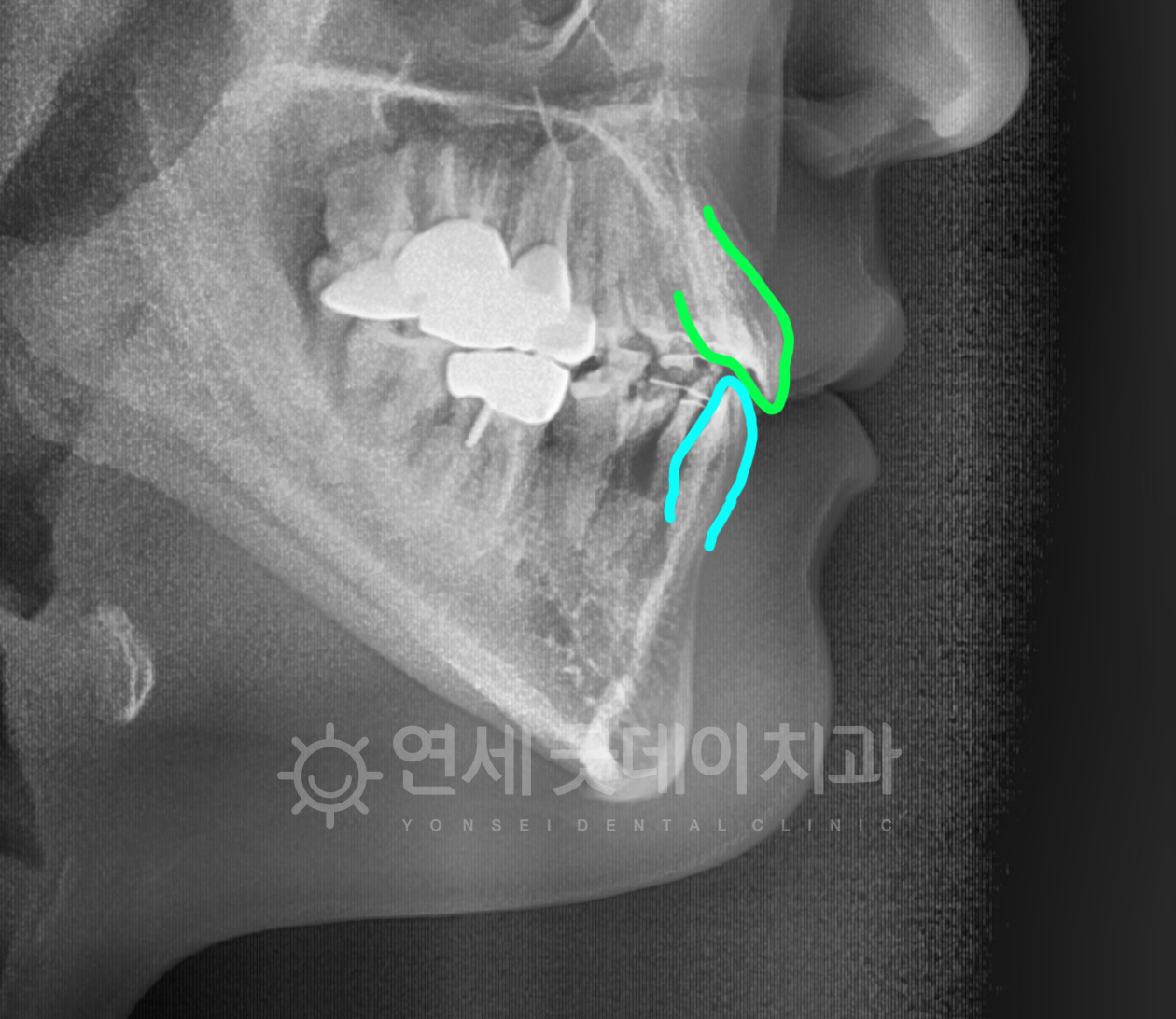 반대교합 교정 후 엑스레이 촬영본
