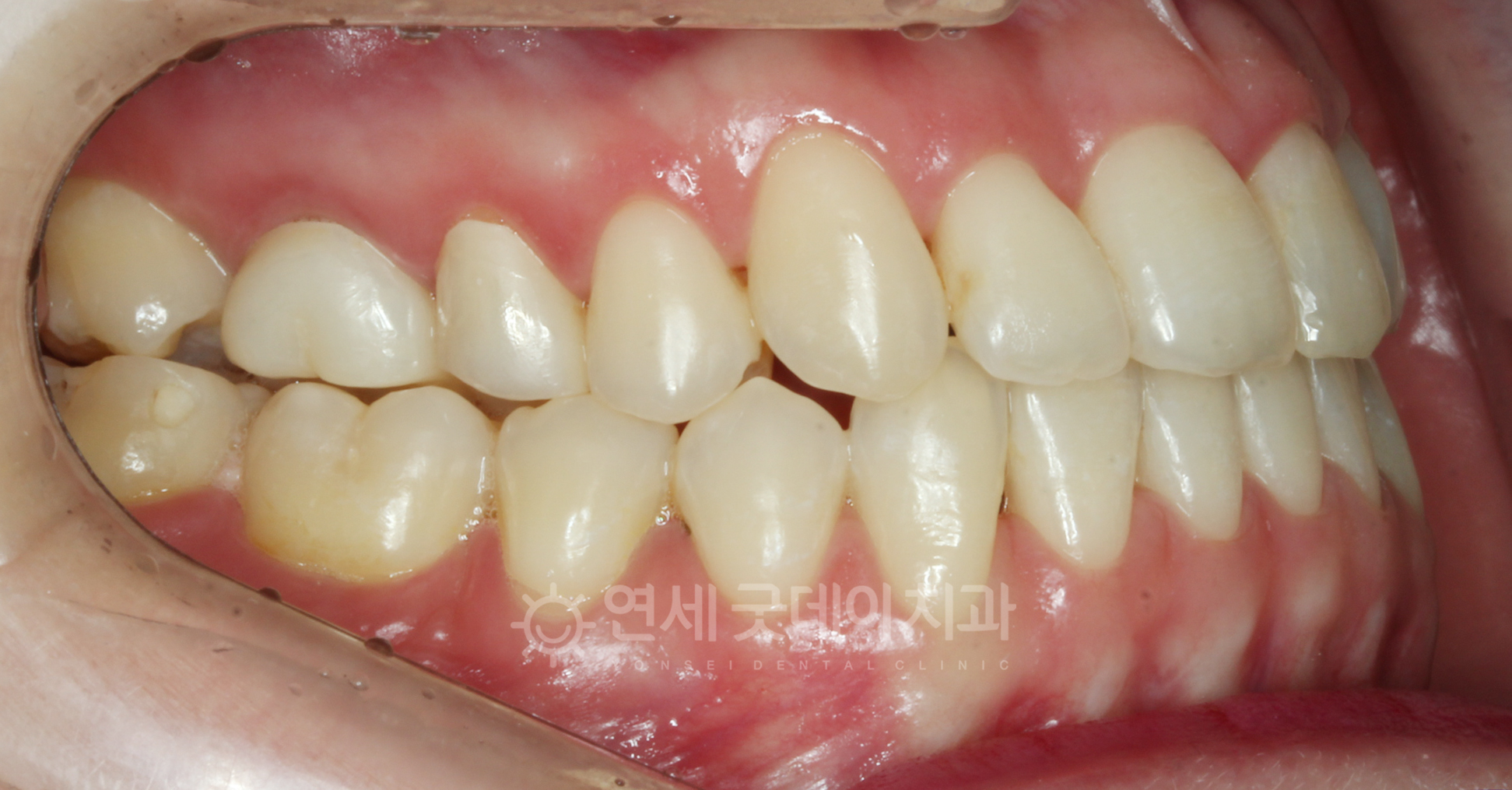 반대교합 교정 후 측면 구내모습으로 염증으로 발치했던 작은 어금니는 큰 어금니가 자리이동하여 기능을 대신함