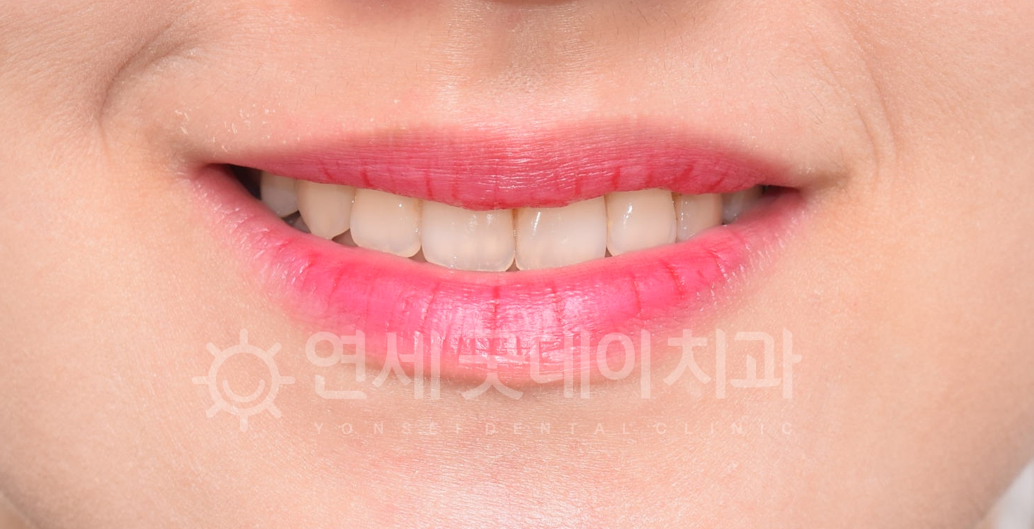 반대교합 교정 후 미소를 짓는 모습