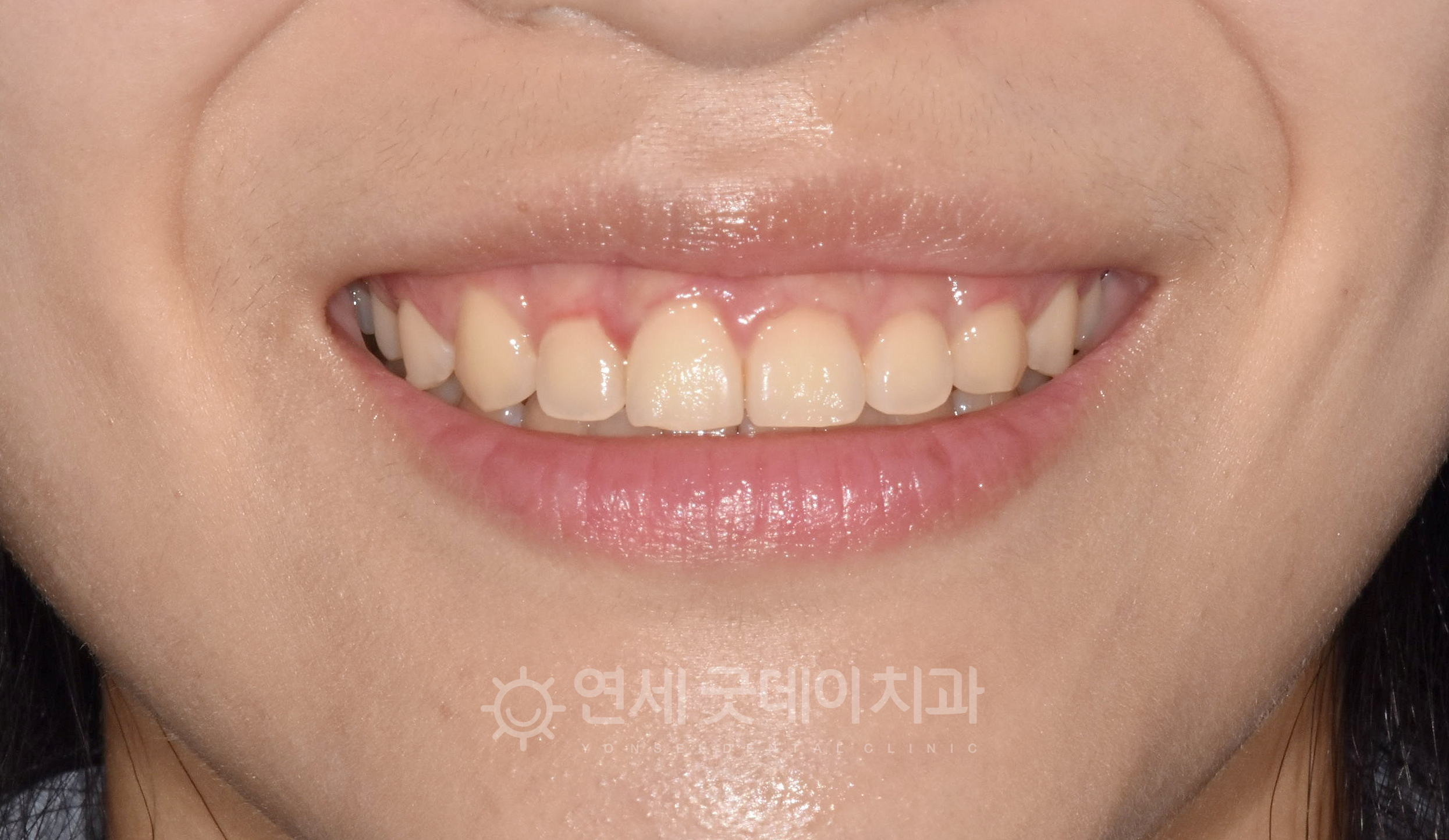 앞니쪽 잇몸 콤플렉스로 잇몸성형(치은절제술)을 하기 위해 내원해주신 20대 여성분