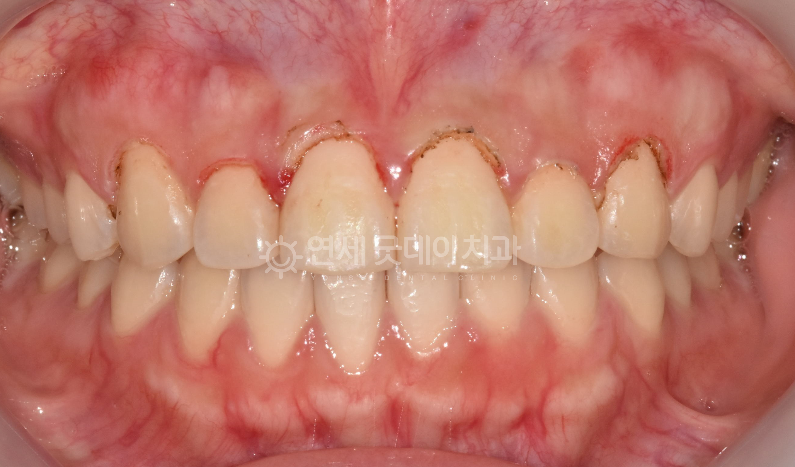 잇몸성형 - 치은절제술 직후 구내모습이며 국소마취 후 진행하기에 환자분이 느끼는 통증은 없으며 출혈도 거의 없는편