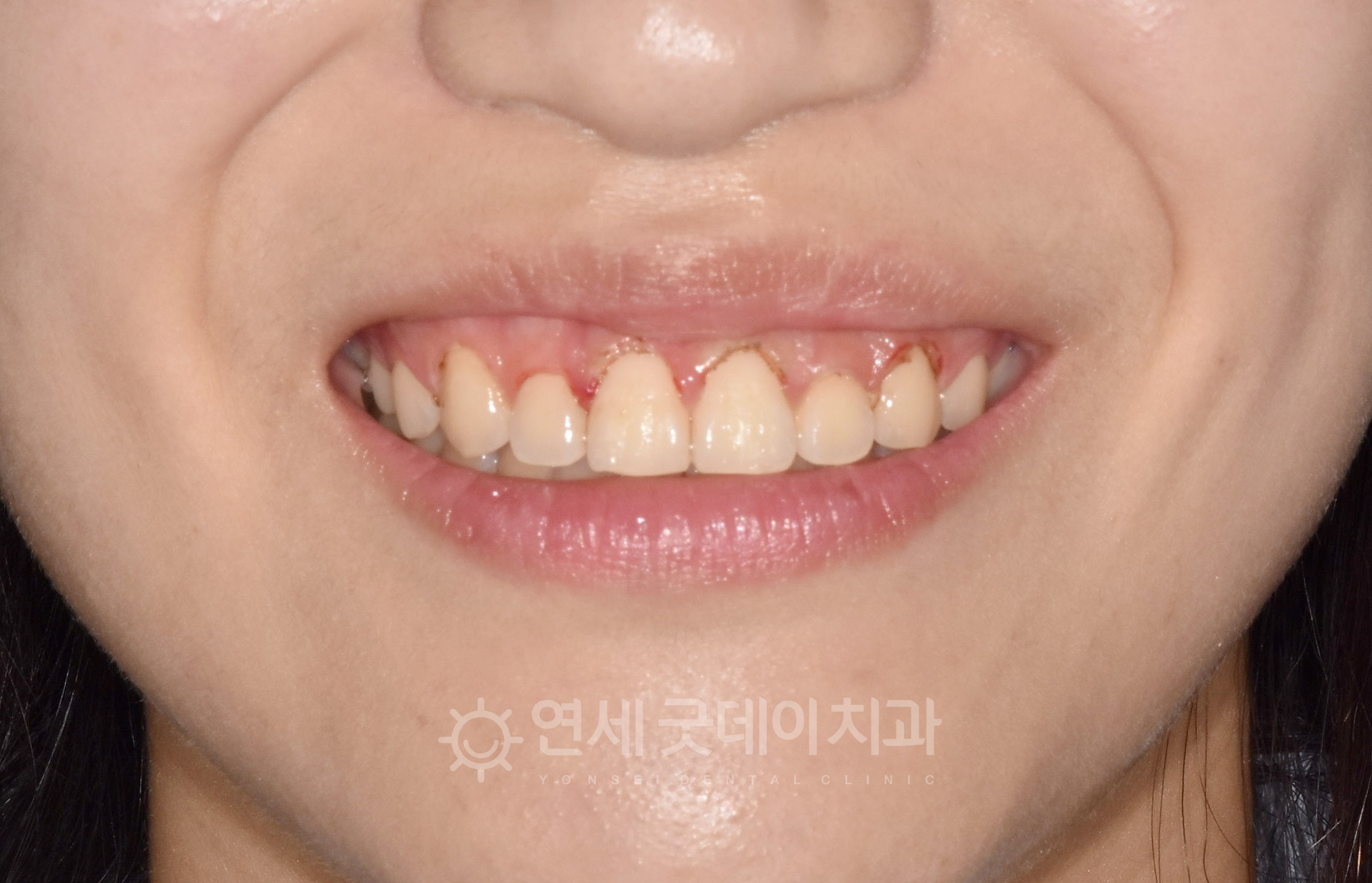 잇몸성형 직후 모습이며 레이저를 통해 치은절제술을 진행하였음