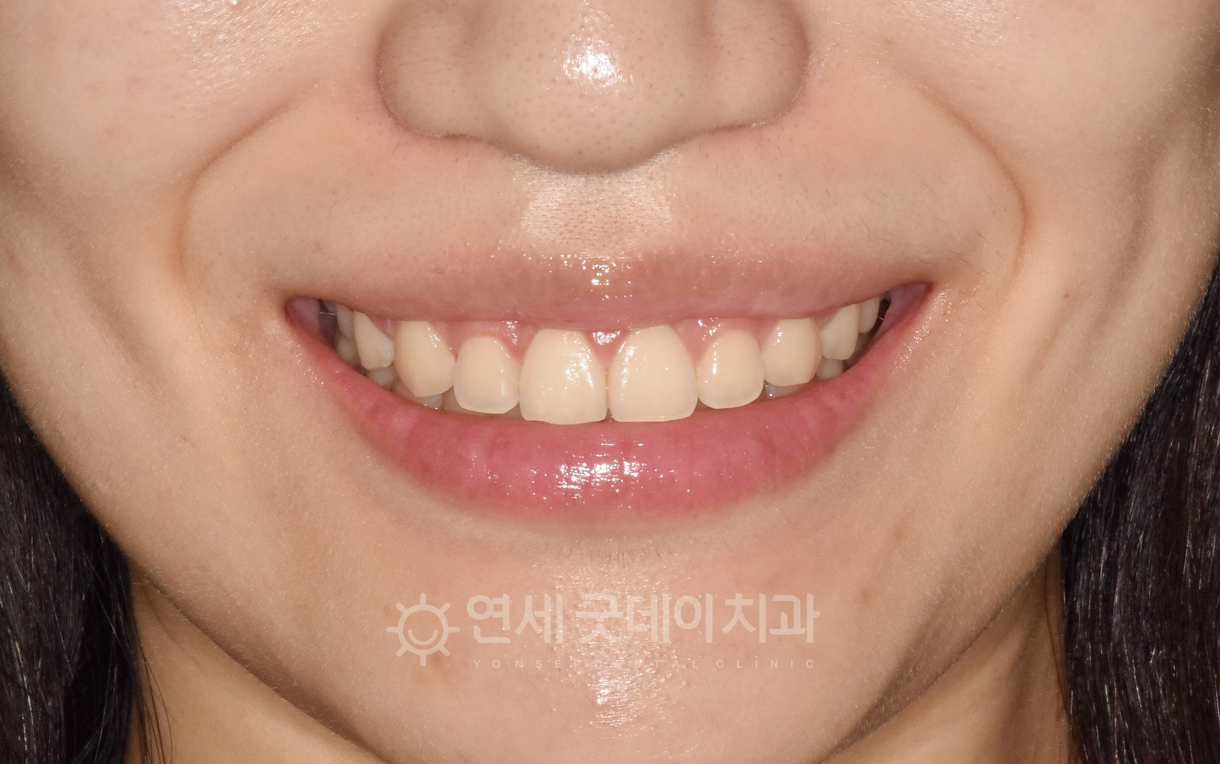 치아의 황금비율에 맞춰 잇몸성형(치은절제술)을 진행하고 한 달 후의 모습. 잇몸라인의 균형이 잡히면서 미소가 더욱 자연스럽고 심미적입니다.