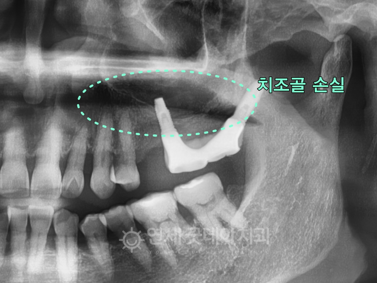 임플란트 재수술 전 엑스레이 사진으로 치조골이 손실되었음