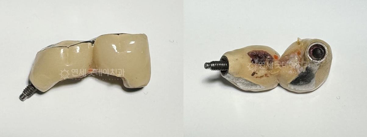 임플란트 재수술 전 타병원에서 진행한 보철물 제거