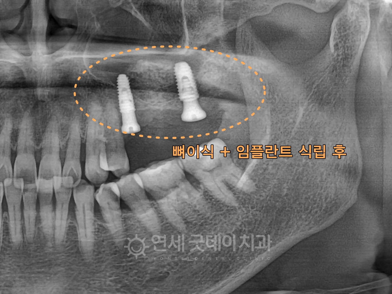 상악동거상술 측방접근법을 통해 임플란트 재수술 후 모습