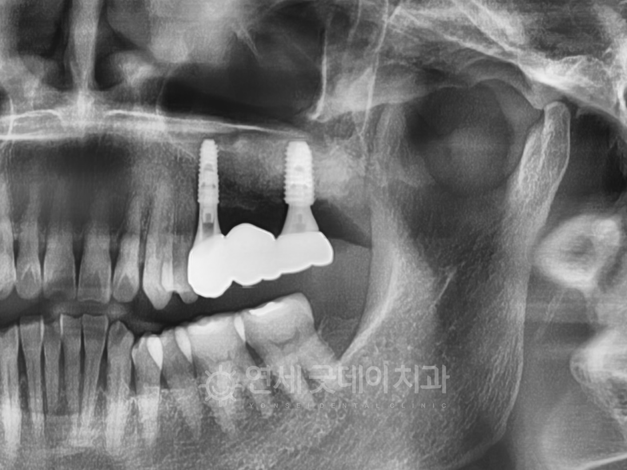 상악동거상술의 측방접근법으로 치료를 완료한 모습